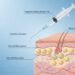A medical diagram illustrates a syringe injecting a solution to disrupt fat cells beneath the skin's surface.
